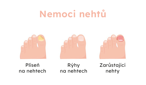Nemoci nehtu